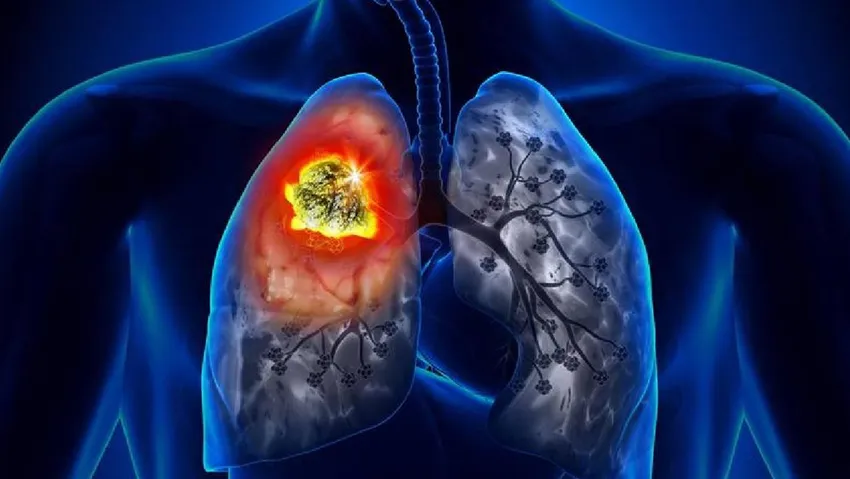 Kanseri daha iyi saptayan ”yapay zeka” geliştirildi