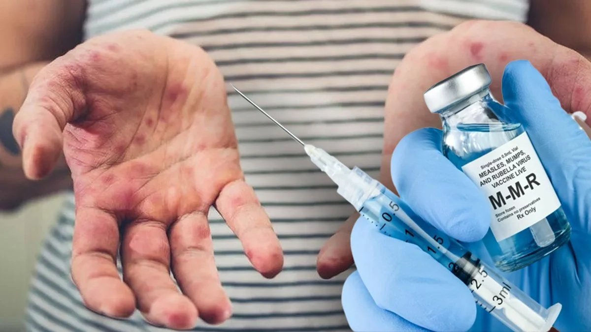 Kızamık vakalarında tehlike koronavirüsten büyük