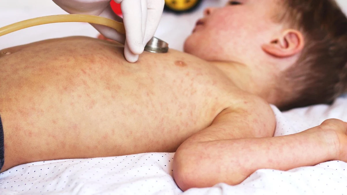 TTB’den kızamık uyarısı