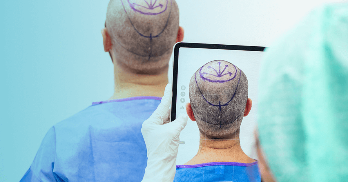 Uzmanlardan saç ektirenlere uyarı!