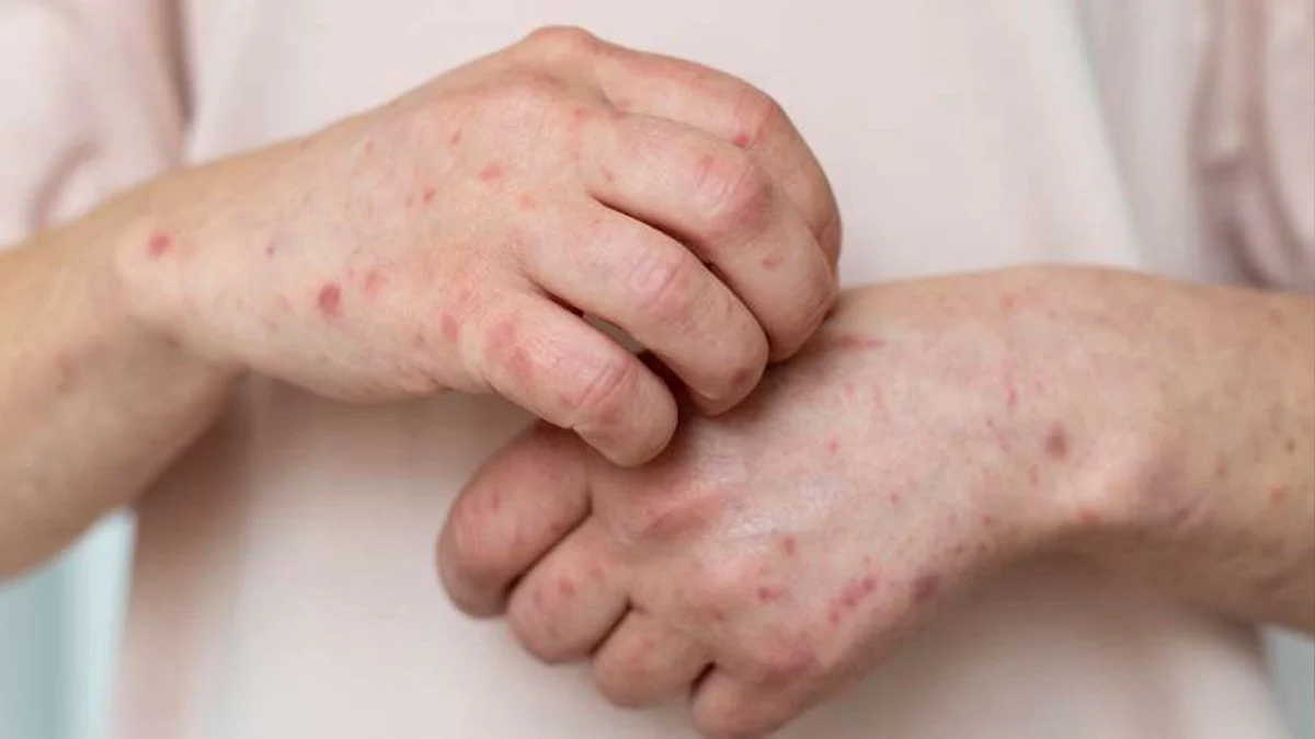 Uyuz vakaları her gün artıyor