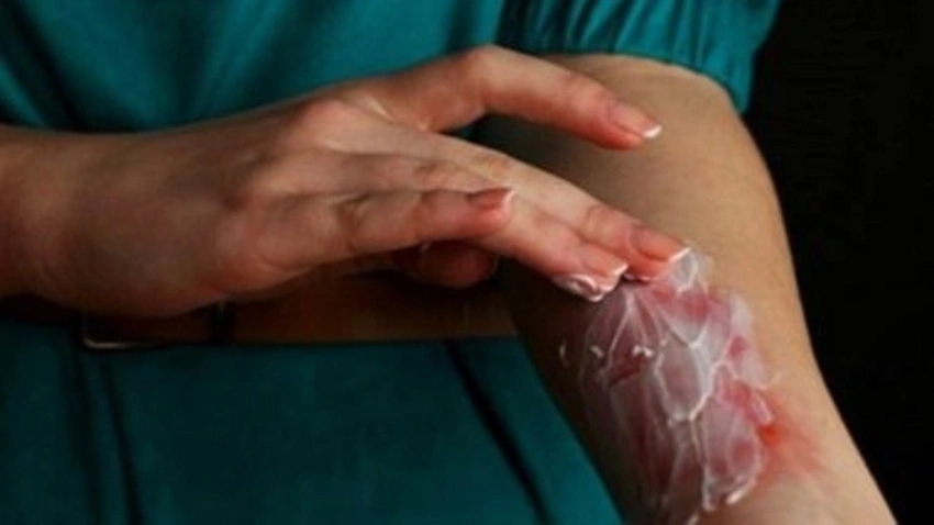 Yanığa yoğurt ve zeytinyağı iyi gelmiyor