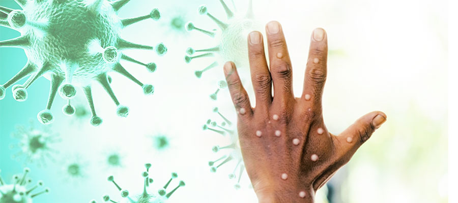 Maymun çiçeği virüsü hızla yayılıyor!