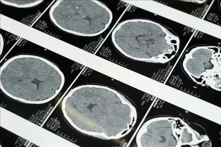 Uzmanlardan masajla gelen inme uyarısı!